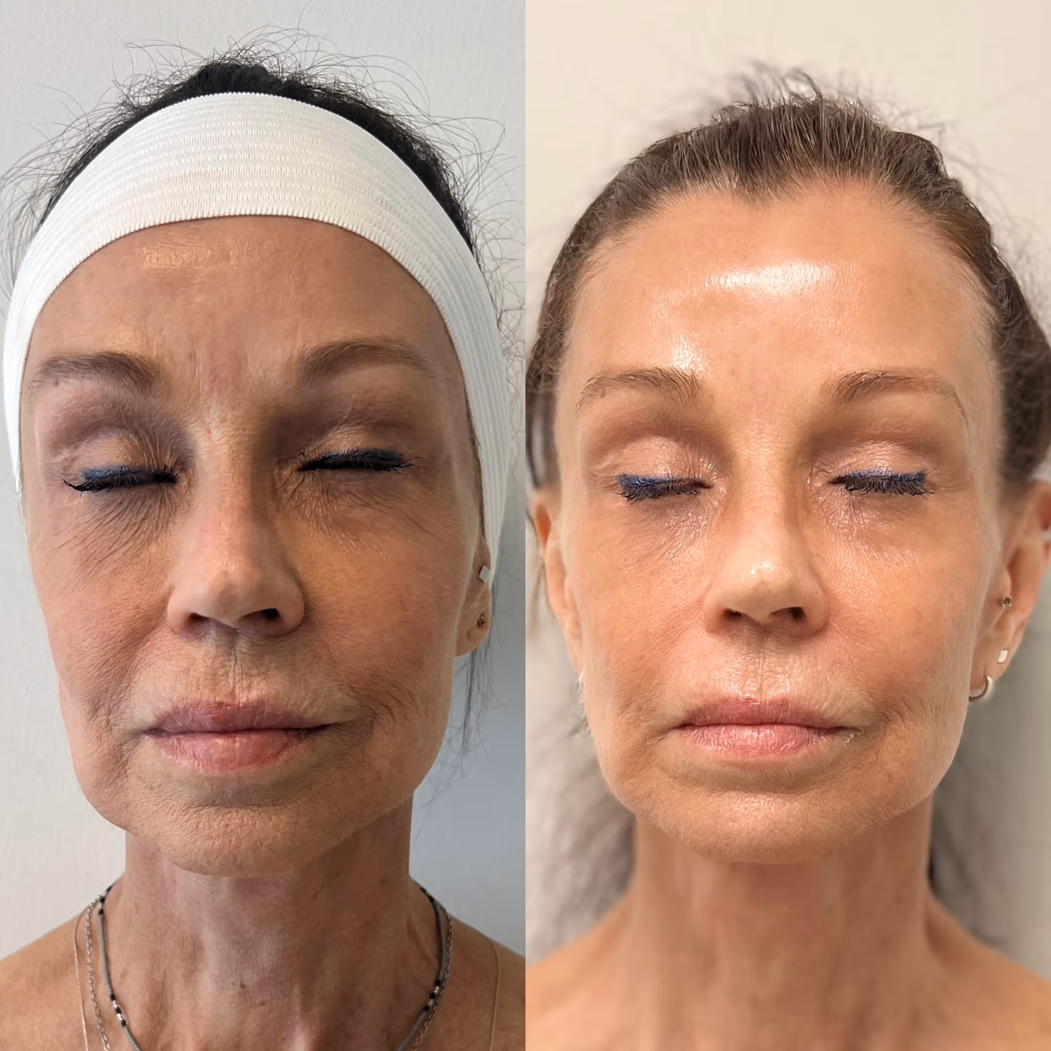 Before and after comparison illustrating visible skin tightening and texture improvement discussed in this Morpheus8 results post