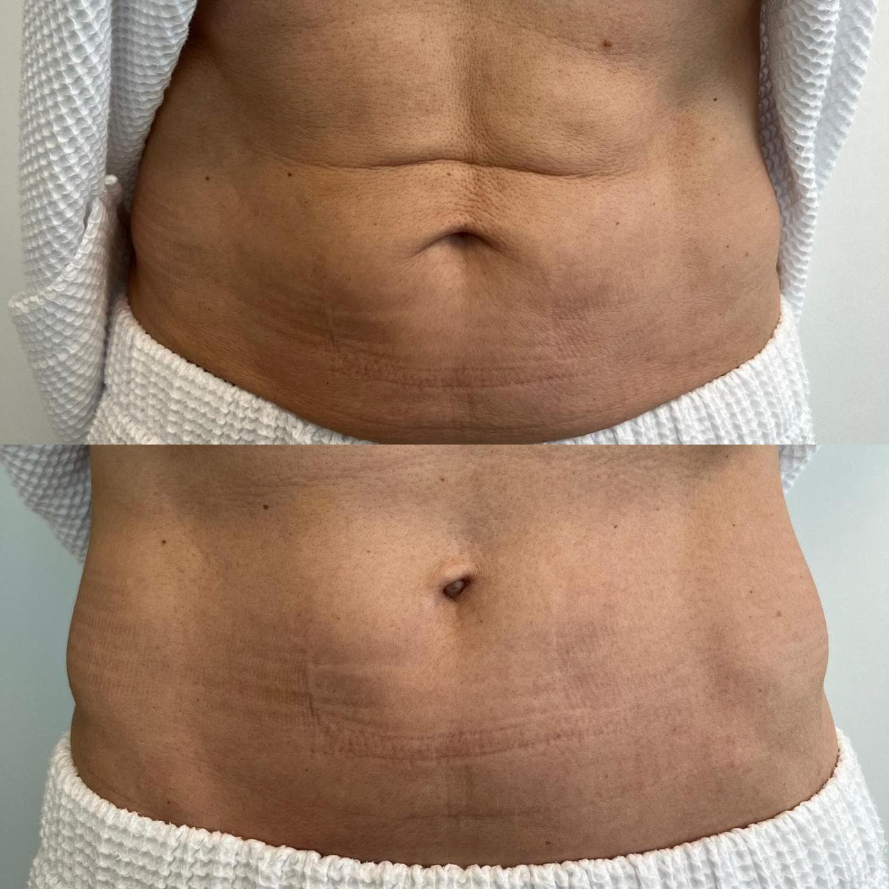 Before and after comparison of abdominal skin laxity showing improved firmness and smoothness after body skin tightening treatment