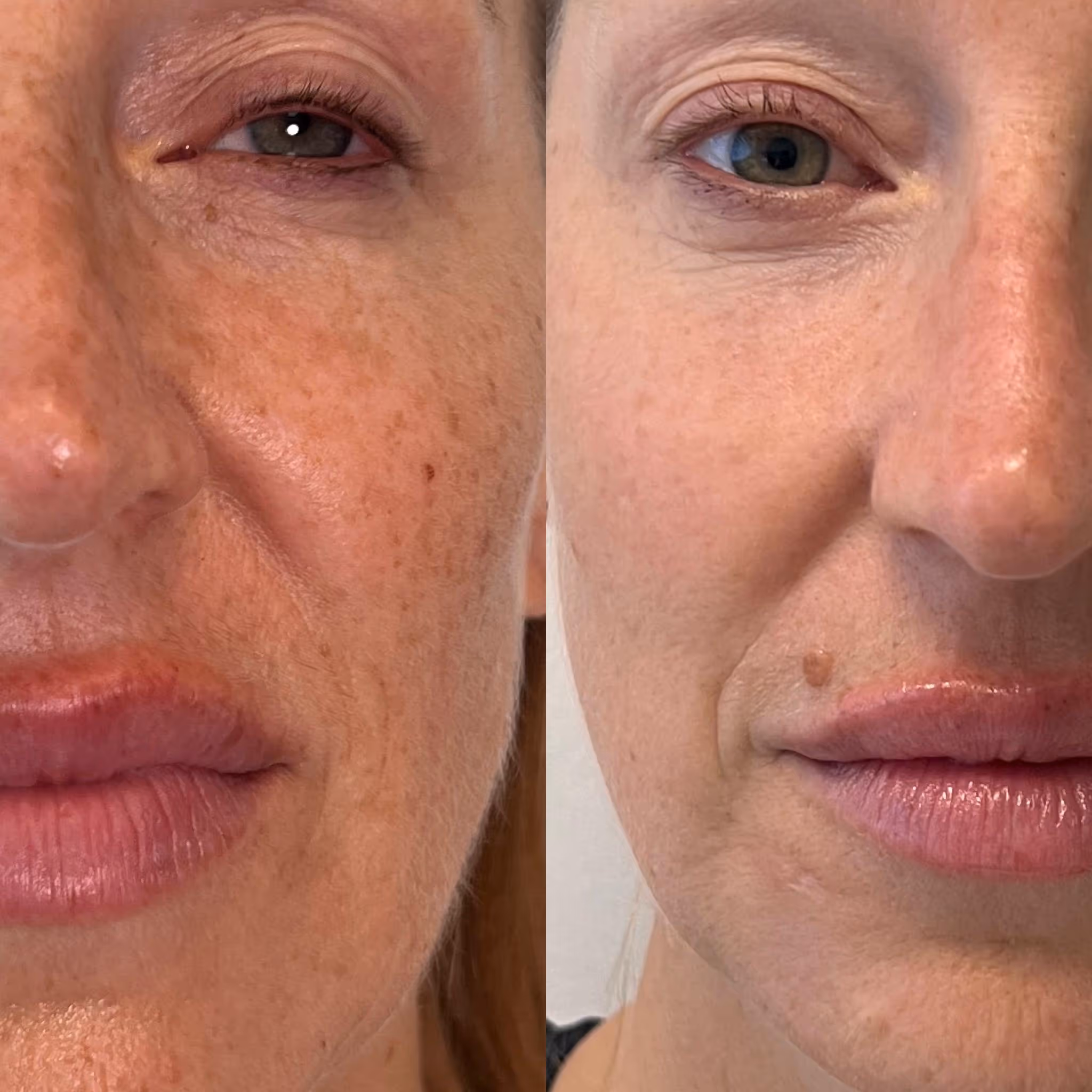 Lumecca Peak IPL treatment room at Infinity Beauty Lab in Brickell, Miami