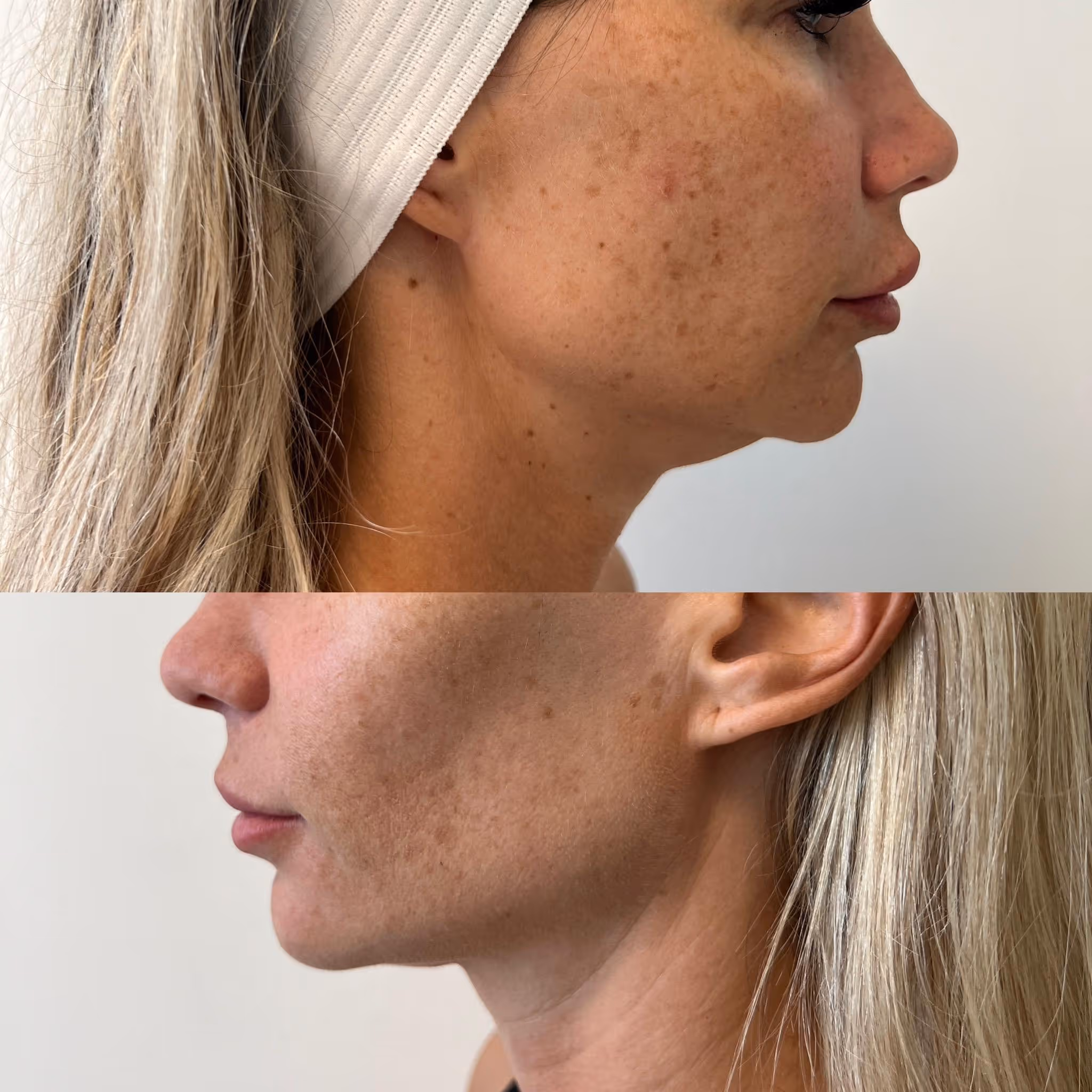 Morpheus8 Burst RF microneedling treatment room at Infinity Beauty Lab in Brickell, Miami